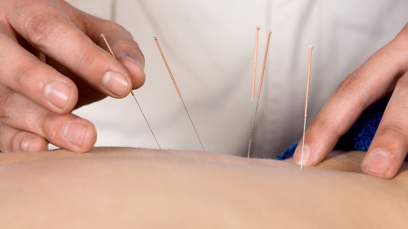 Acupuncture